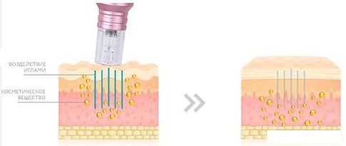 Прибор для мезотерапии Gezatone AMG517 (зеленый)